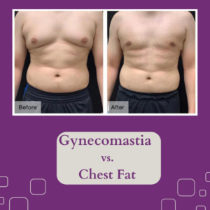 Gynecomastia-vs.-Chest-Fat
