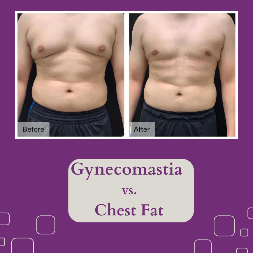 Difference Between Gynecomastia And Chest Fat - PharmEasy Blog