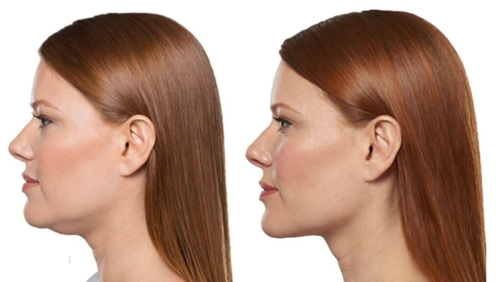 JAW CONTOURS