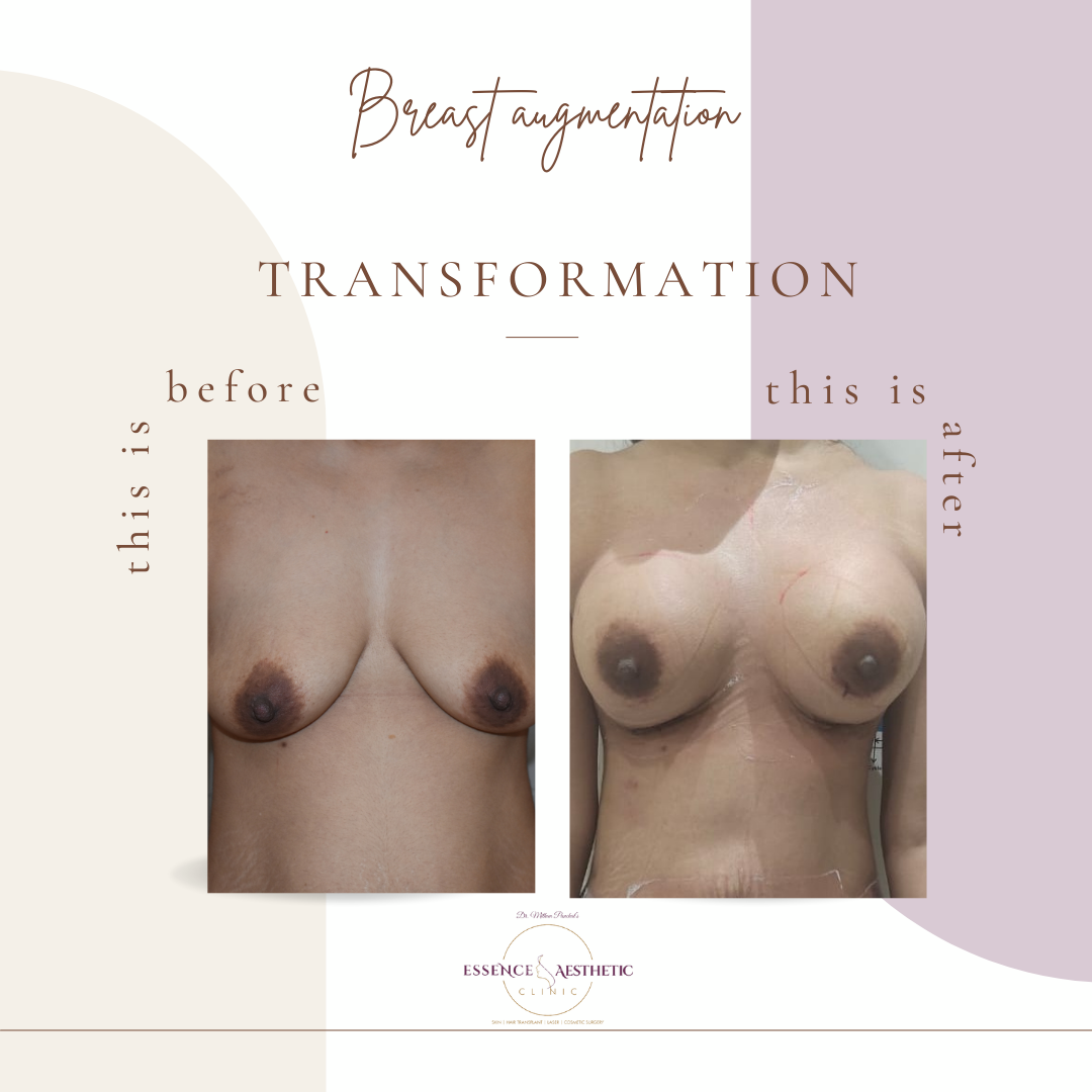 breast-augmentation before after