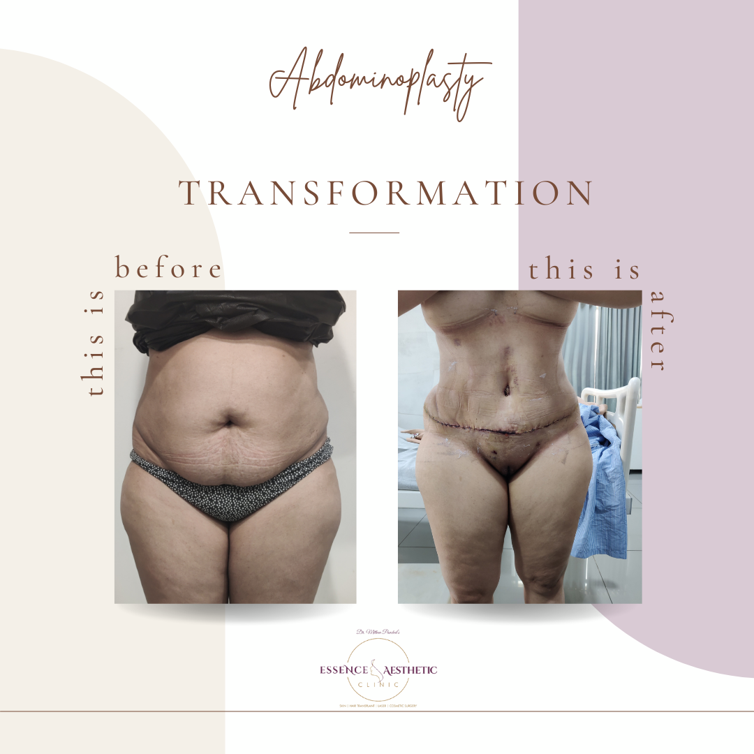 abdominoplasty before and after