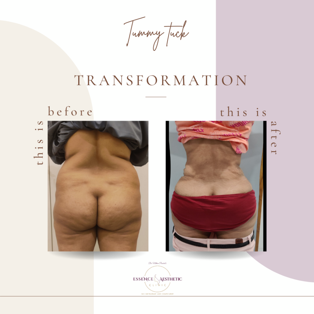 Tummy Tuck Surgery in Vadodara Tummy Tuck Surgery Cost