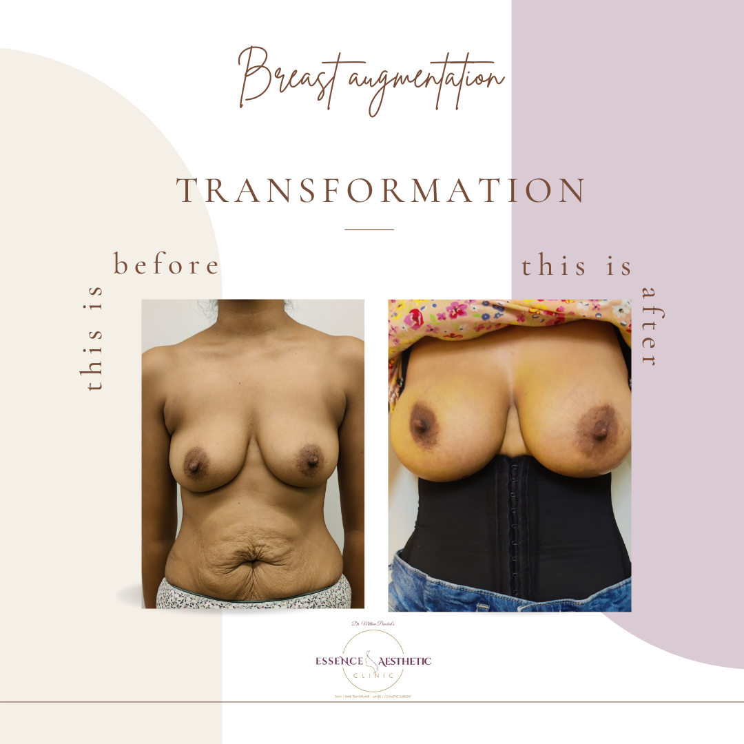 breast-augmentation before after