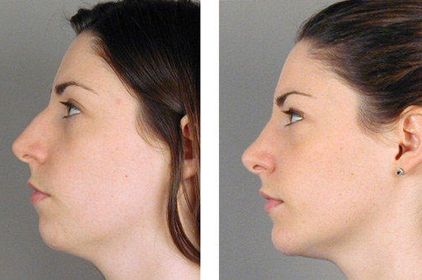 CHEEK IMPLANTS