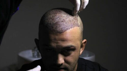 Get Natural Looking Hair with a Hair Transplant in Vadodara