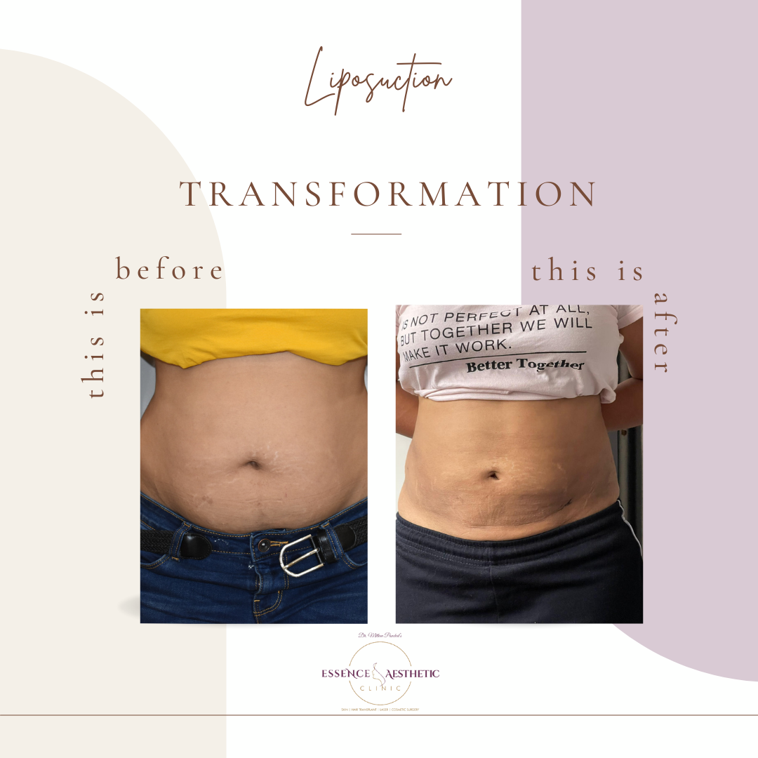 Liposuction Surgery Transformation