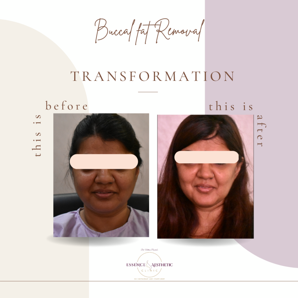 buccal fat removal