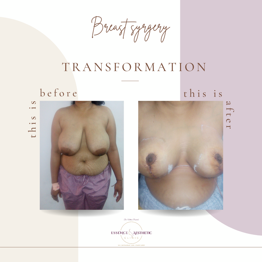 breast surgery before or after
