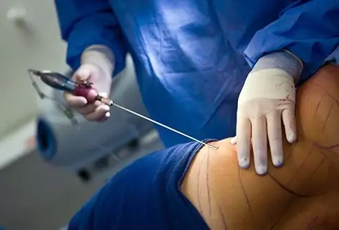 liposuction-techniques