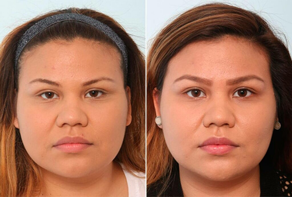 Patient Buccal Fat Pad Removal Before After