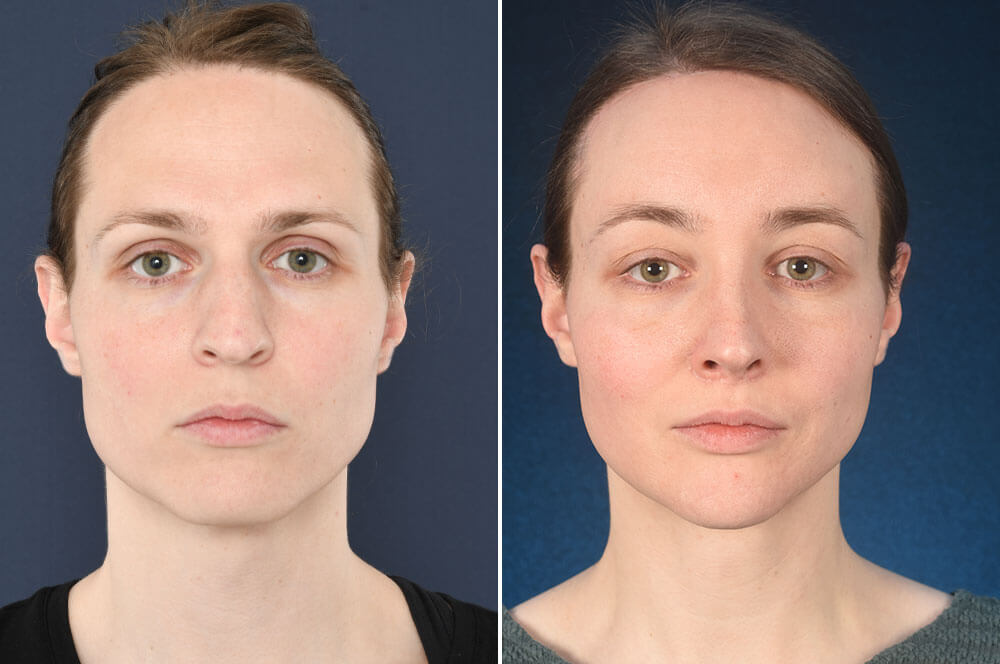 Simone Before And After Facial Feminization Surgery 1 