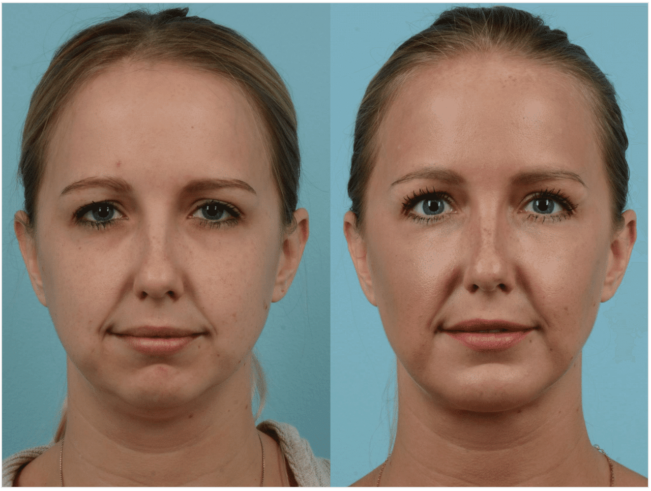 BUCCAL FAT REMOVAL