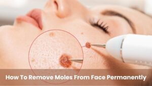 How to Remove Moles from Face Permanently