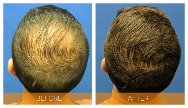 Hair Transplant 6 Months vs. 1 year