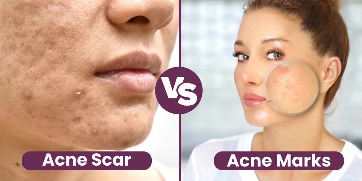 Acne Scar vs Acne Marks