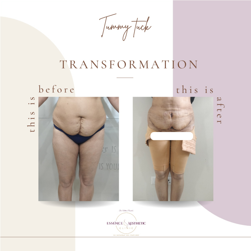 Tummy Tuck Before After