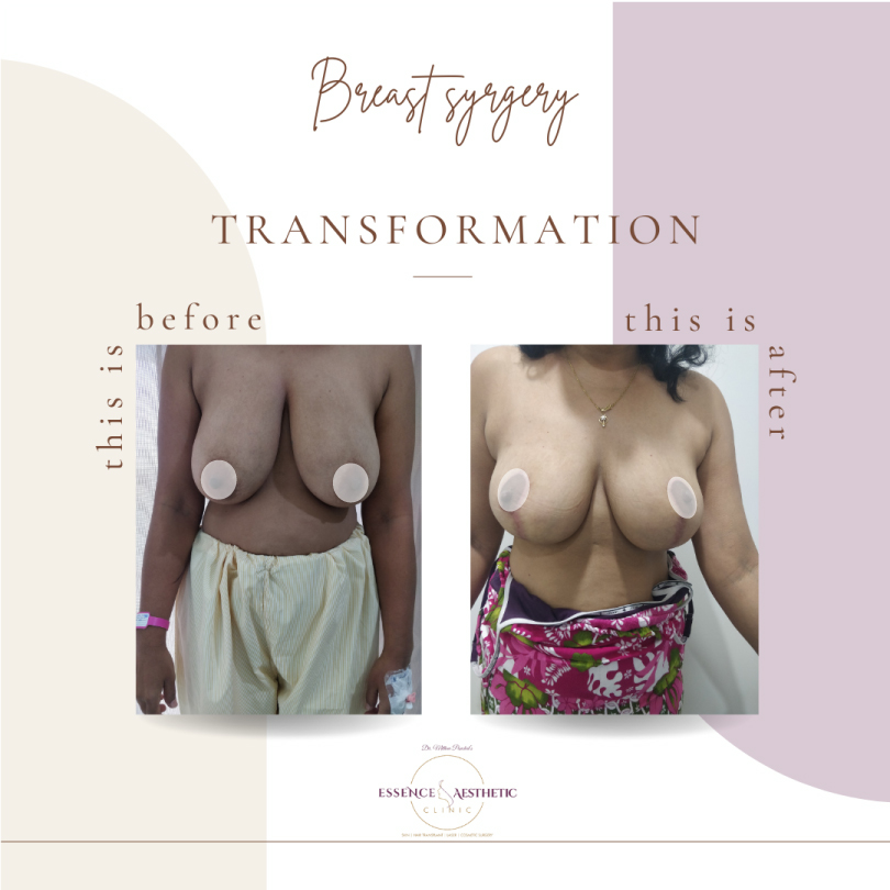 breast Surgery
