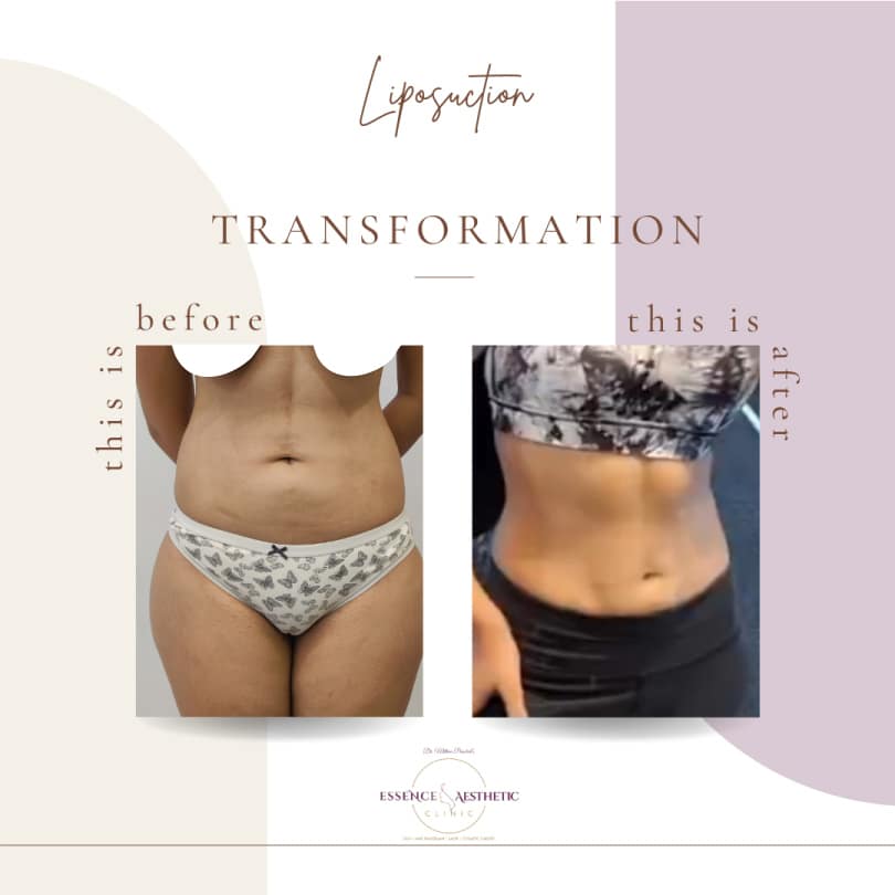 liposuction before after