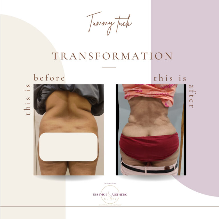 Tummy Tuck Before After