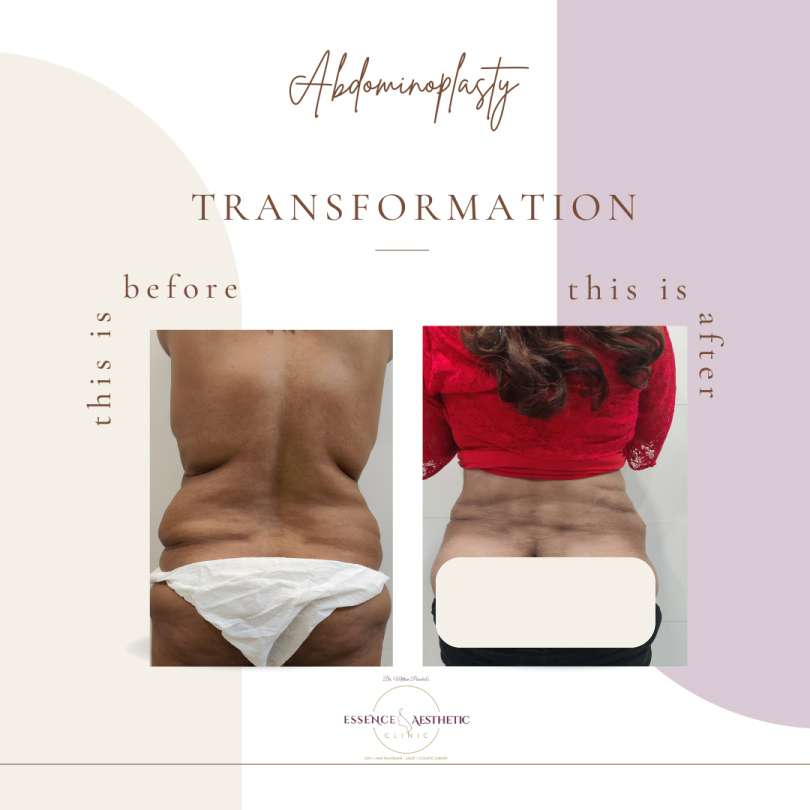 Abdominoplasty Before After