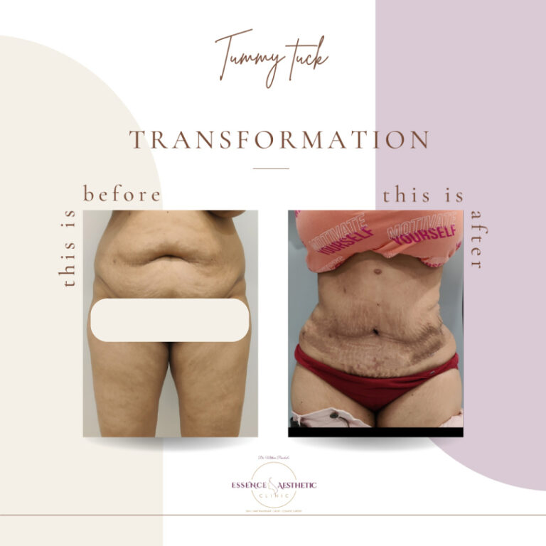 Tummy Tuck Before After