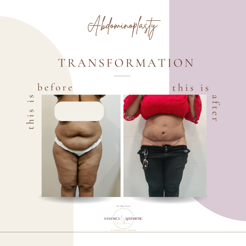 Abdominoplasty Before After