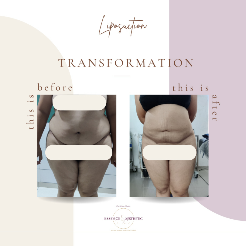 Liposuction