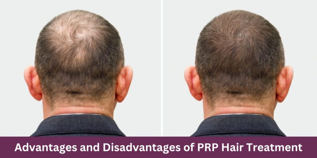 Advantages and Disadvantages of prp Hair Treatment