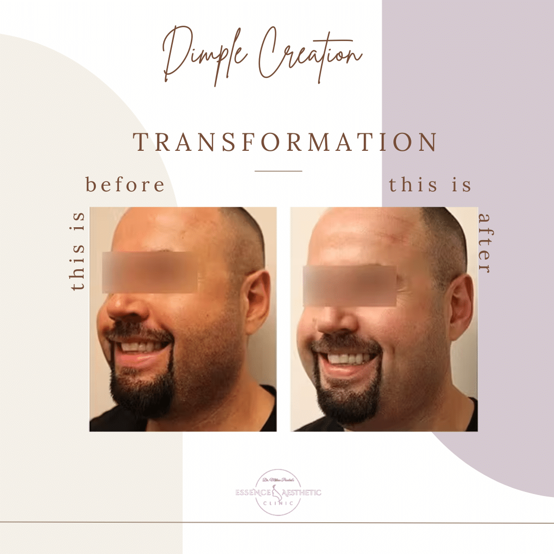 DIMPLE CREATION