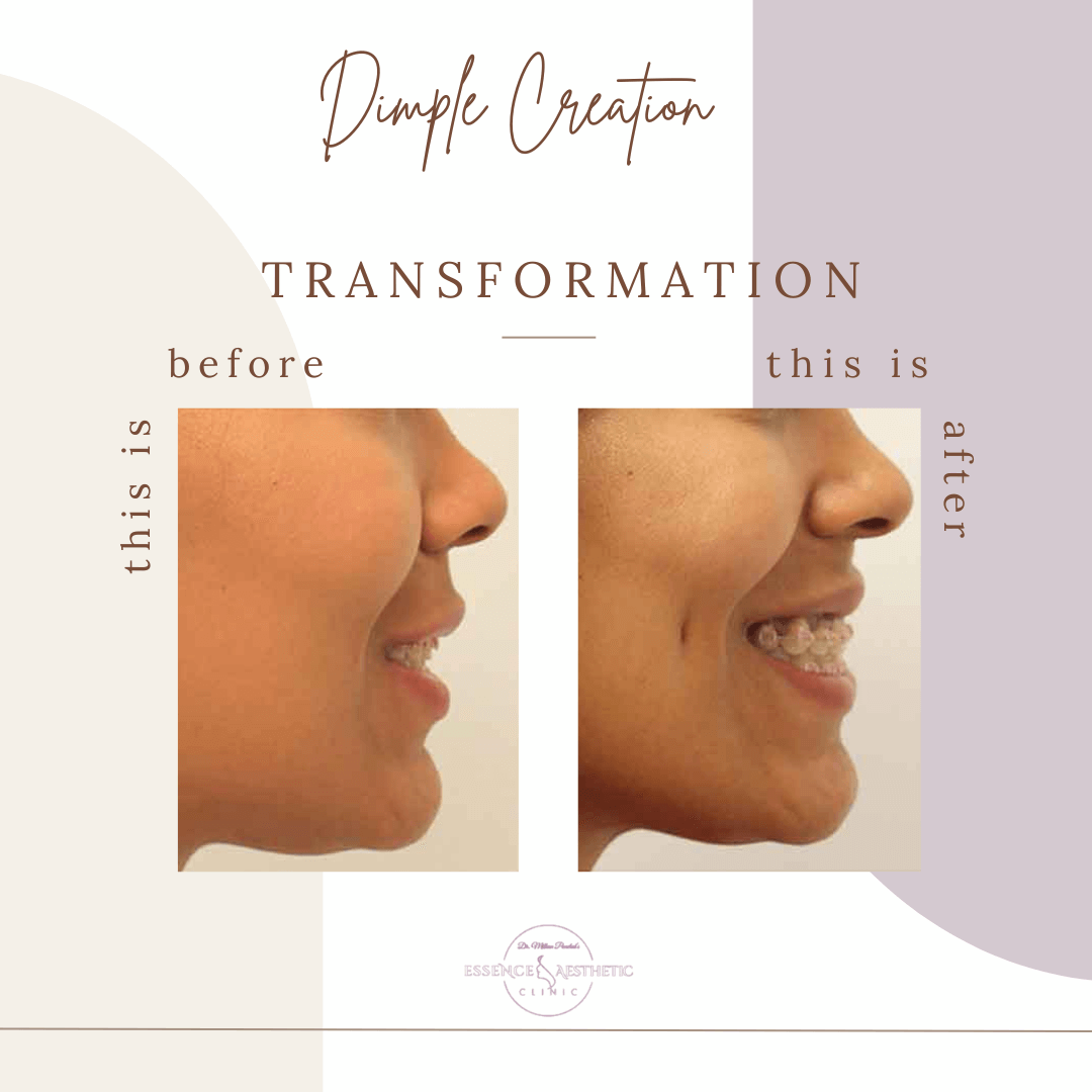 DIMPLE CREATION before after