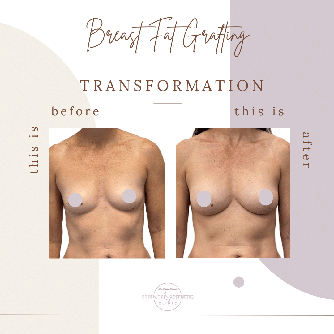 Breast Augmentation