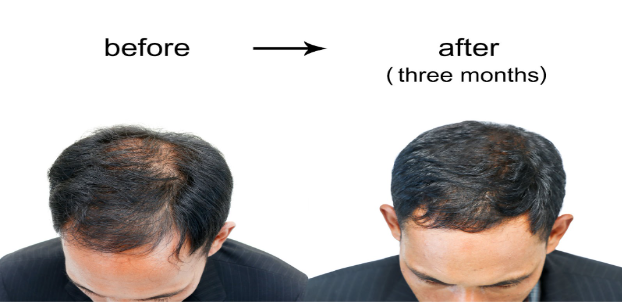 Advantages and Disadvantages of prp Hair Treatment