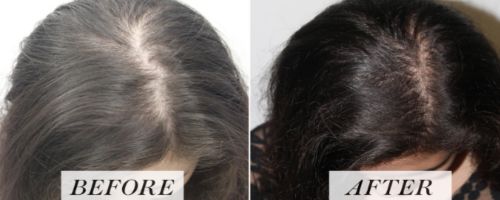 prp Treatment