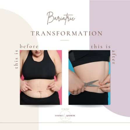 bariatric surgery