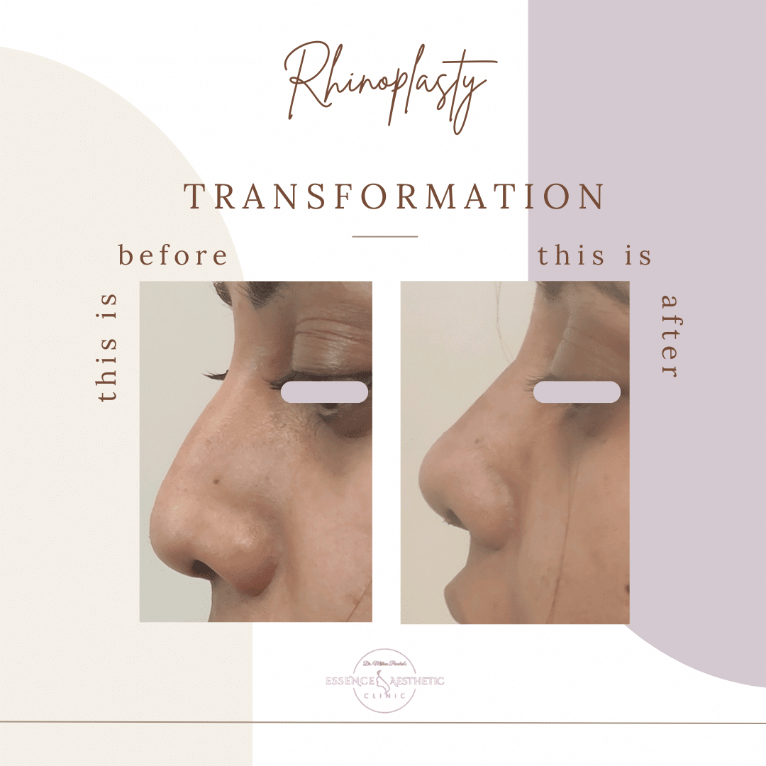 before after Rhinoplasty