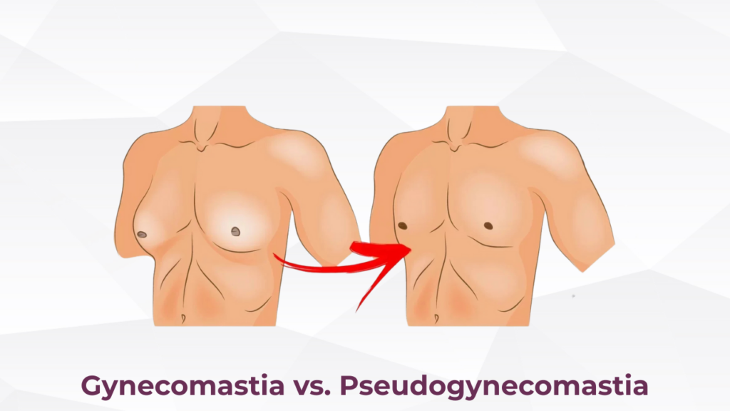 Gynecomastia vs. Pseudogynecomastia