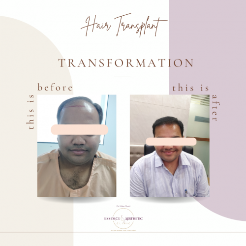 hair transplant before and after