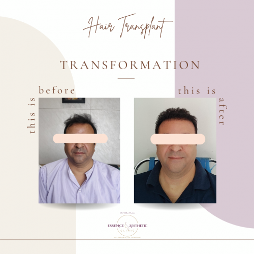 hair transplant before and after