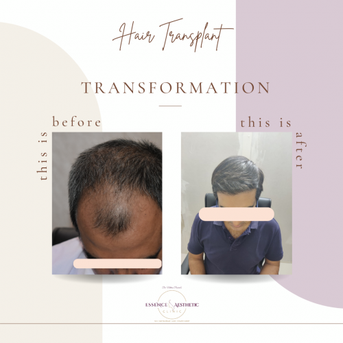 hair transplant before and after