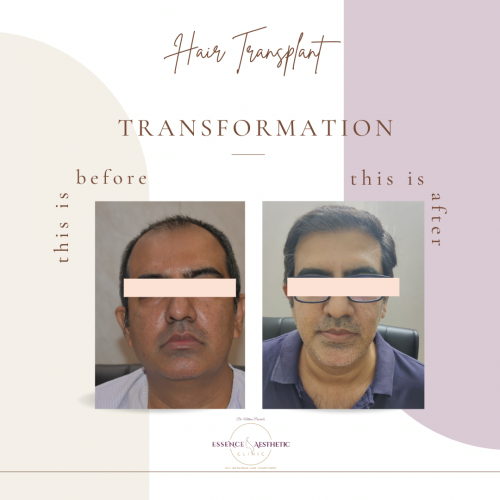hair transplant before and after
