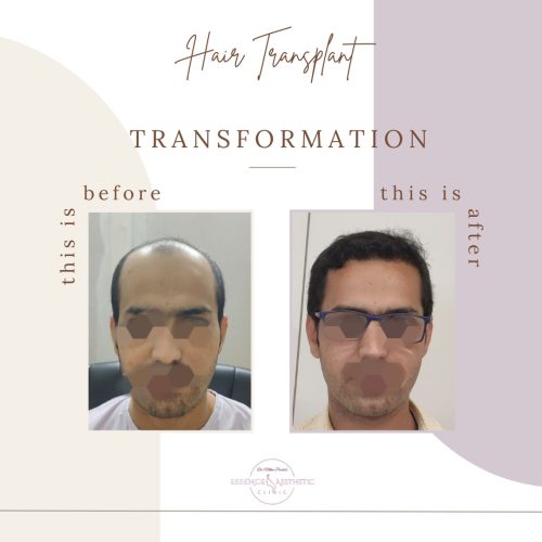 Hair Transplant Before After