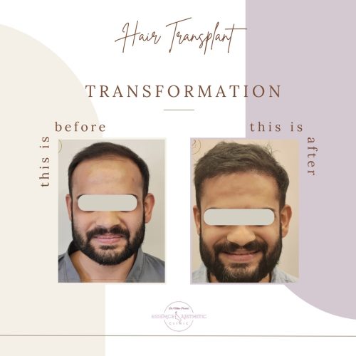 Hair Transplant Before After