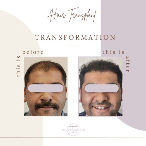 Hair Transplant Before After