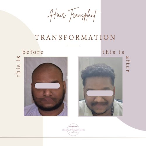 Hair Transplant Before After