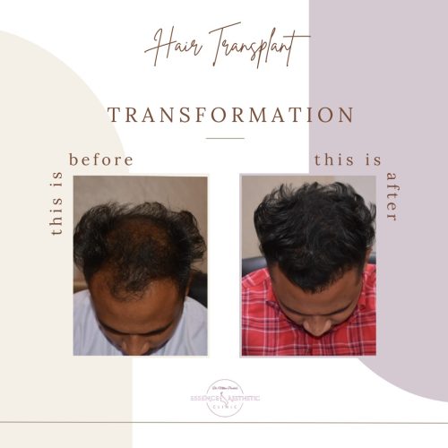 Hair Transplant Before After