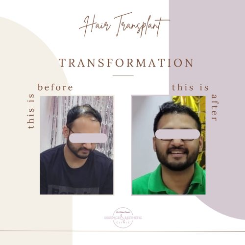 Hair Transplant Before After