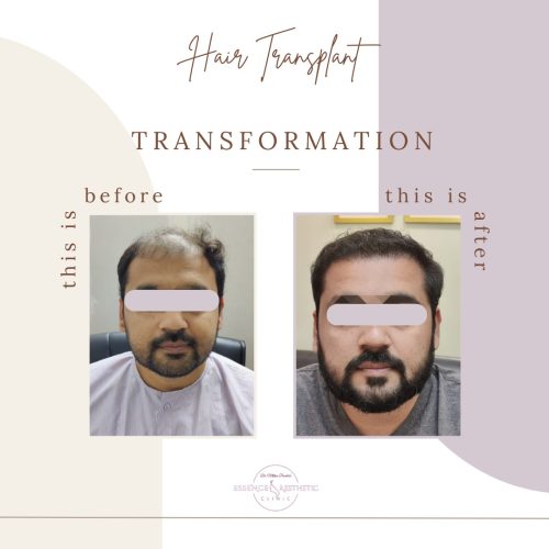 Hair Transplant Before After